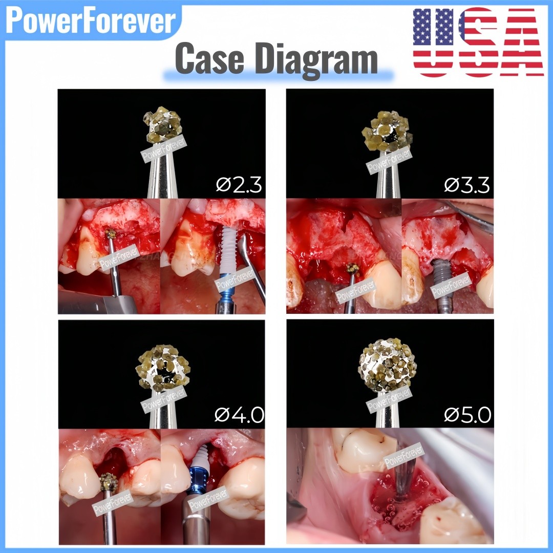 USA Dental Degranulation Burs Kit Bone Debridement Remove Tissue Debris Remnant