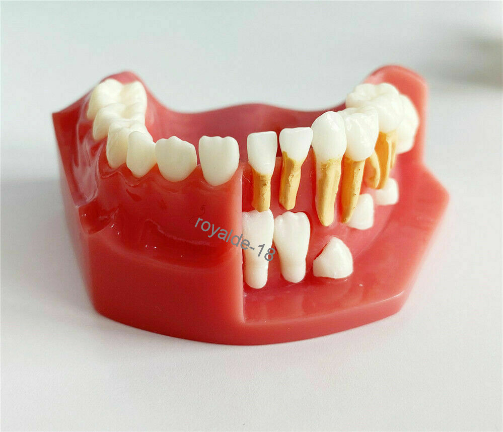 Dental Teaching Pediatrics Teeth Children 5-9Years Old Permanent Alternate Model
