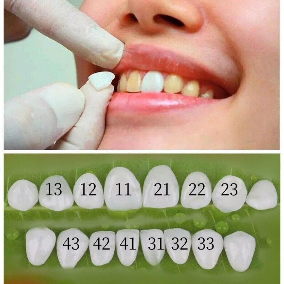 6Pcs/Set Teeth Veneer Dental Veneers Tooth Whitening Ceramic Anterior LMS