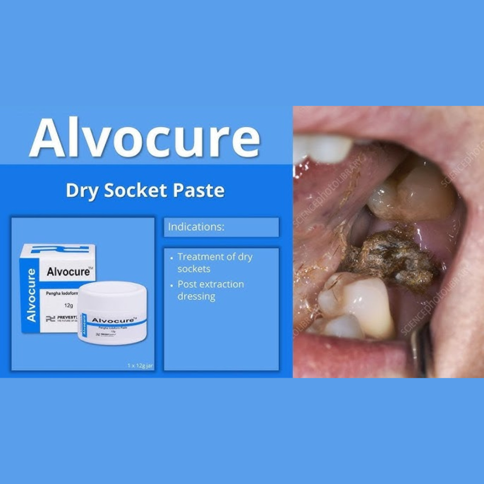 Prevest Denpro Alvocure Dental Dry Socket Paste Alveolitis Dressing Iodoform Jar