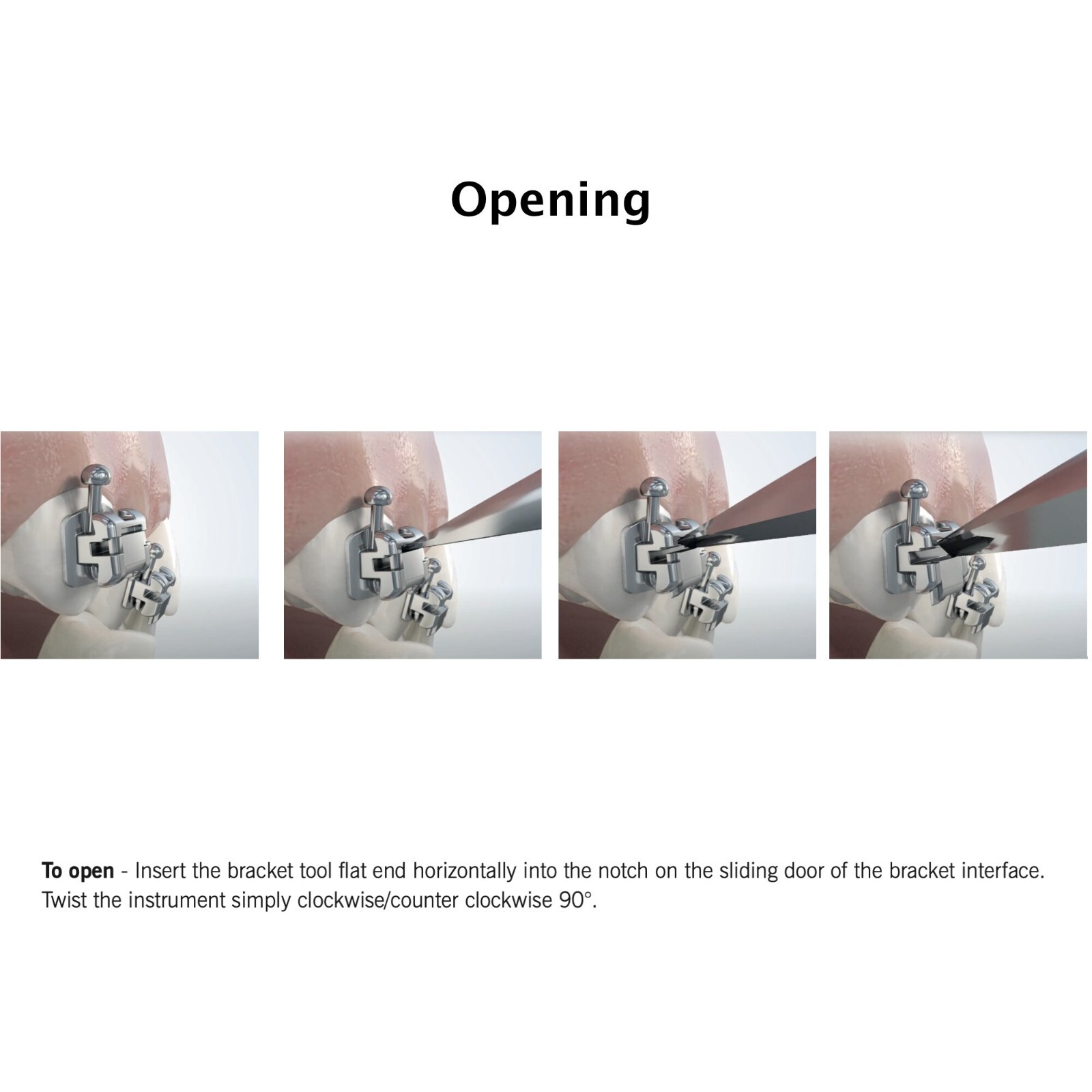 Orthodontic Self Ligating Brackets Buccal Tubes 7-7 Thomas M Roth MBT 022 Damon