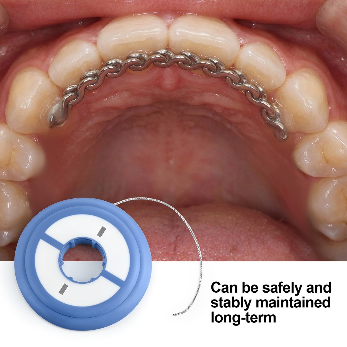 Orthodontic Dental Lingual Retainer Wire Stainless Steel Retention Wires Chain