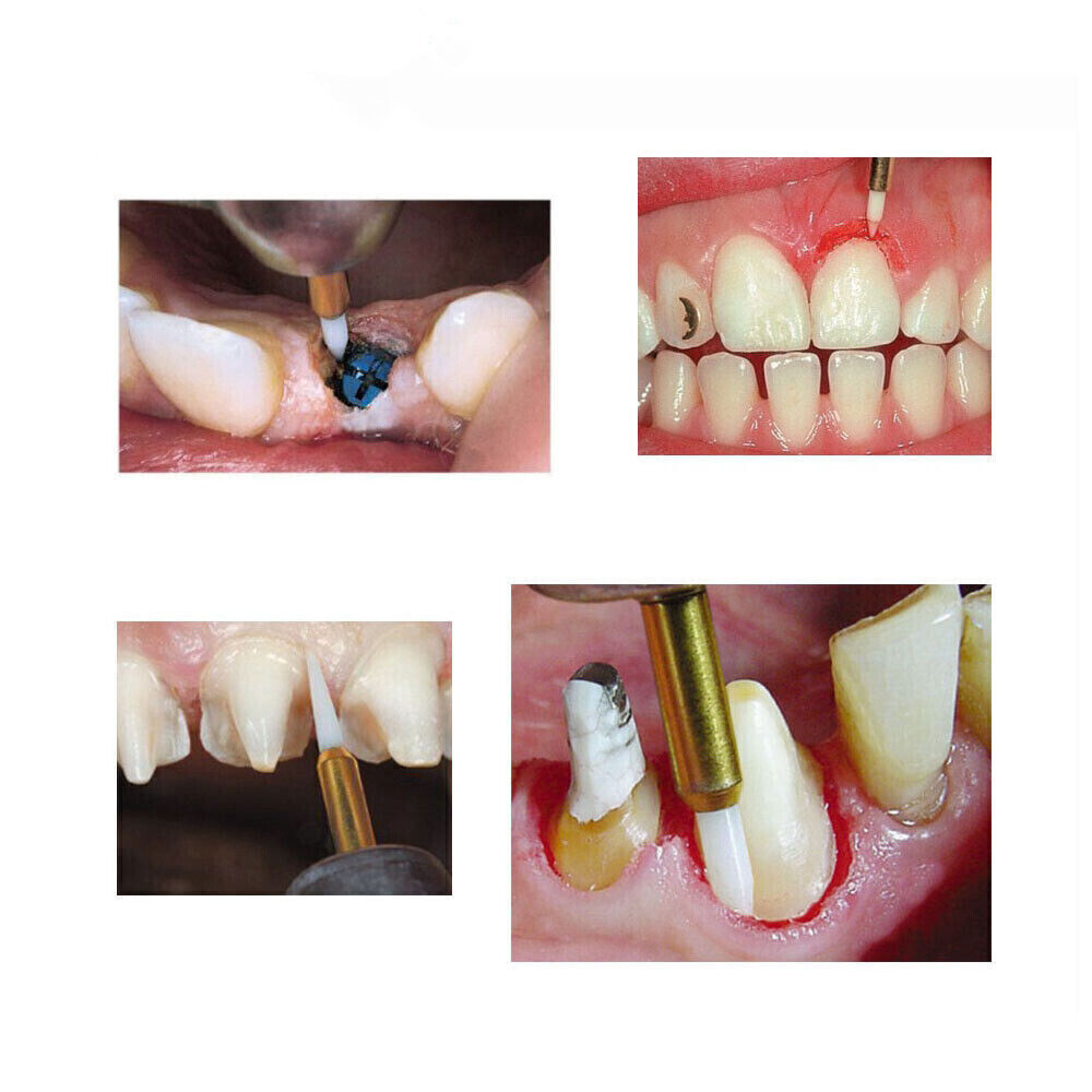 Dental Soft Tissue Trimmer Ceramic Bur Gingival Gingivectomy 21/23mm