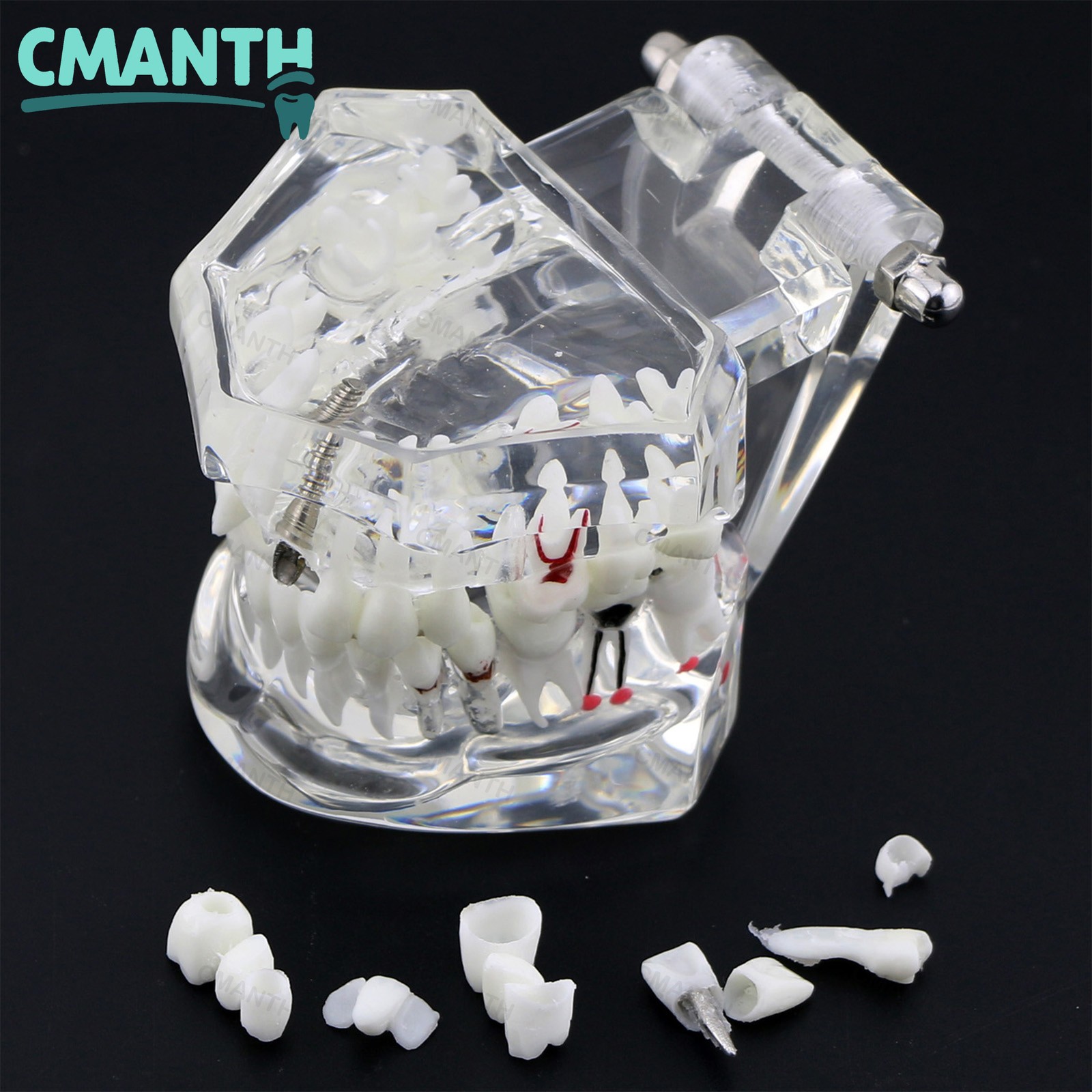 US Dental Repairable Model Implant Teeth Model Dentist Teaching Pathology Study