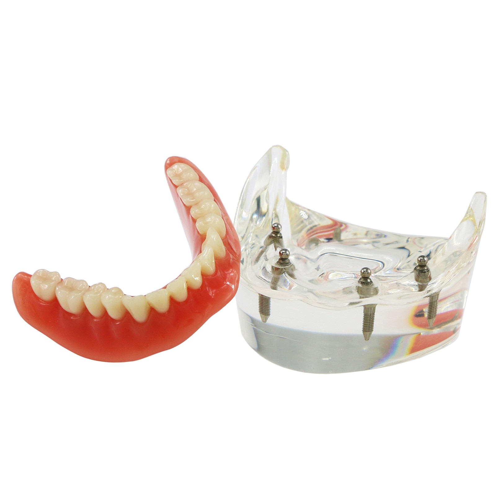 US Dental Removable Overdenture Teeth Model 4 lmplants Restoration Demo Clear