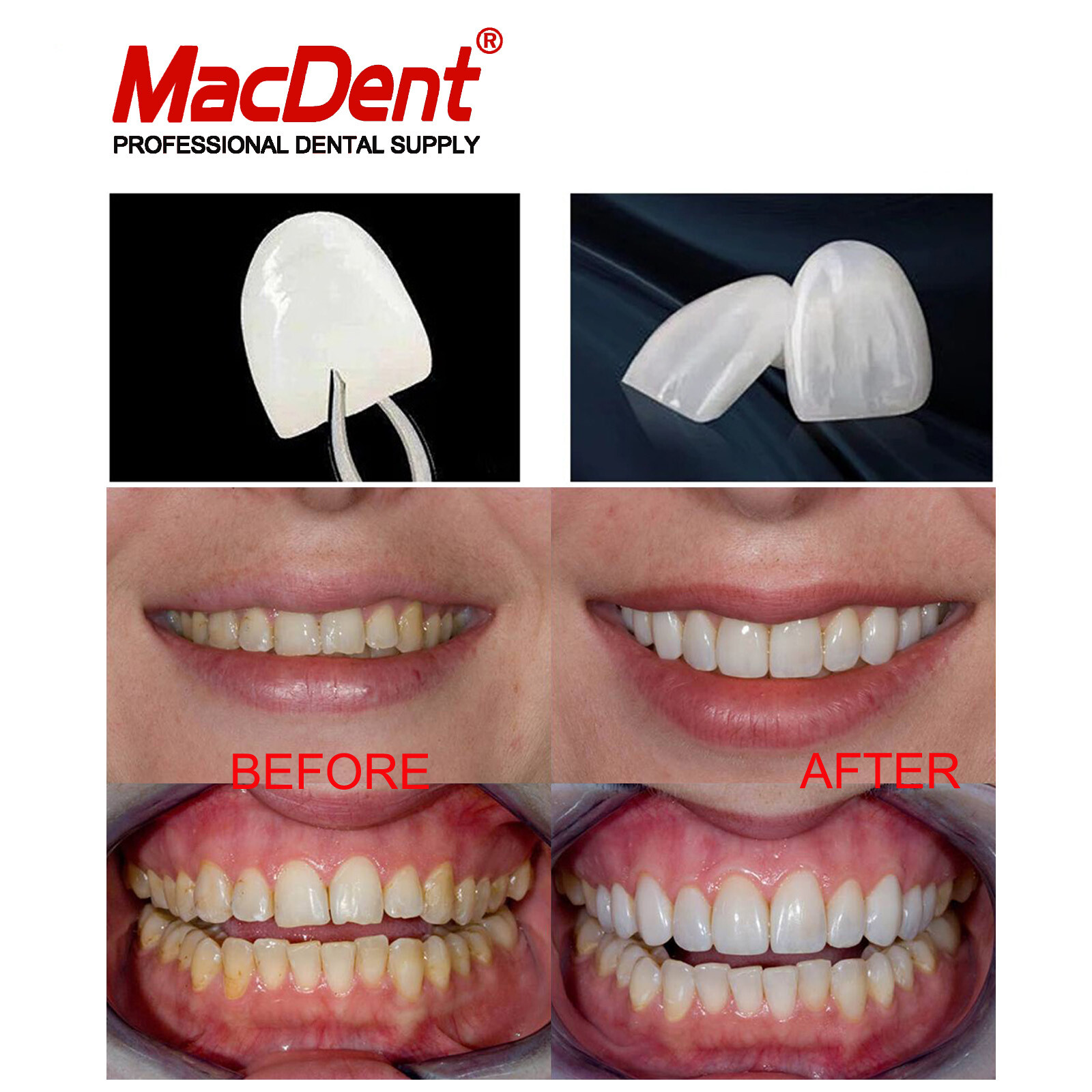 6Pcs/Set Teeth Veneer Dental Veneers Tooth Whitening Ceramic Anterior LMS