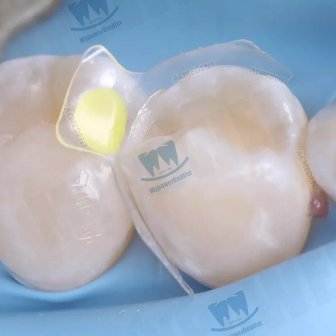 Clear Matrix Dental Diastema Matrices Wedge Similar with Bio Clear Matrice TORVM