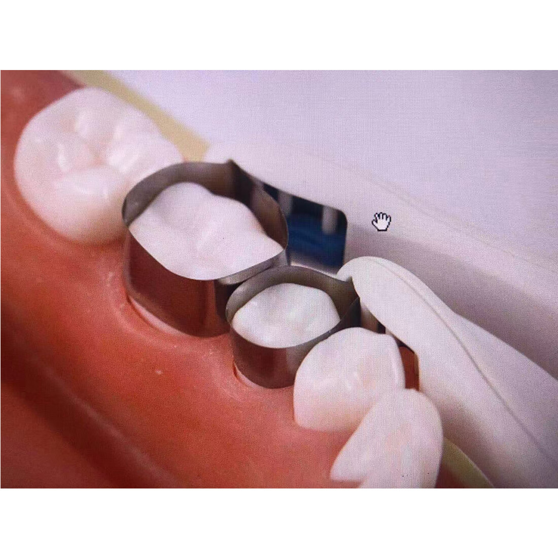 10Pcs Easyinsmile Dental Pro Matrix Band Ring Adjustable Matrices Standard 4.5mm