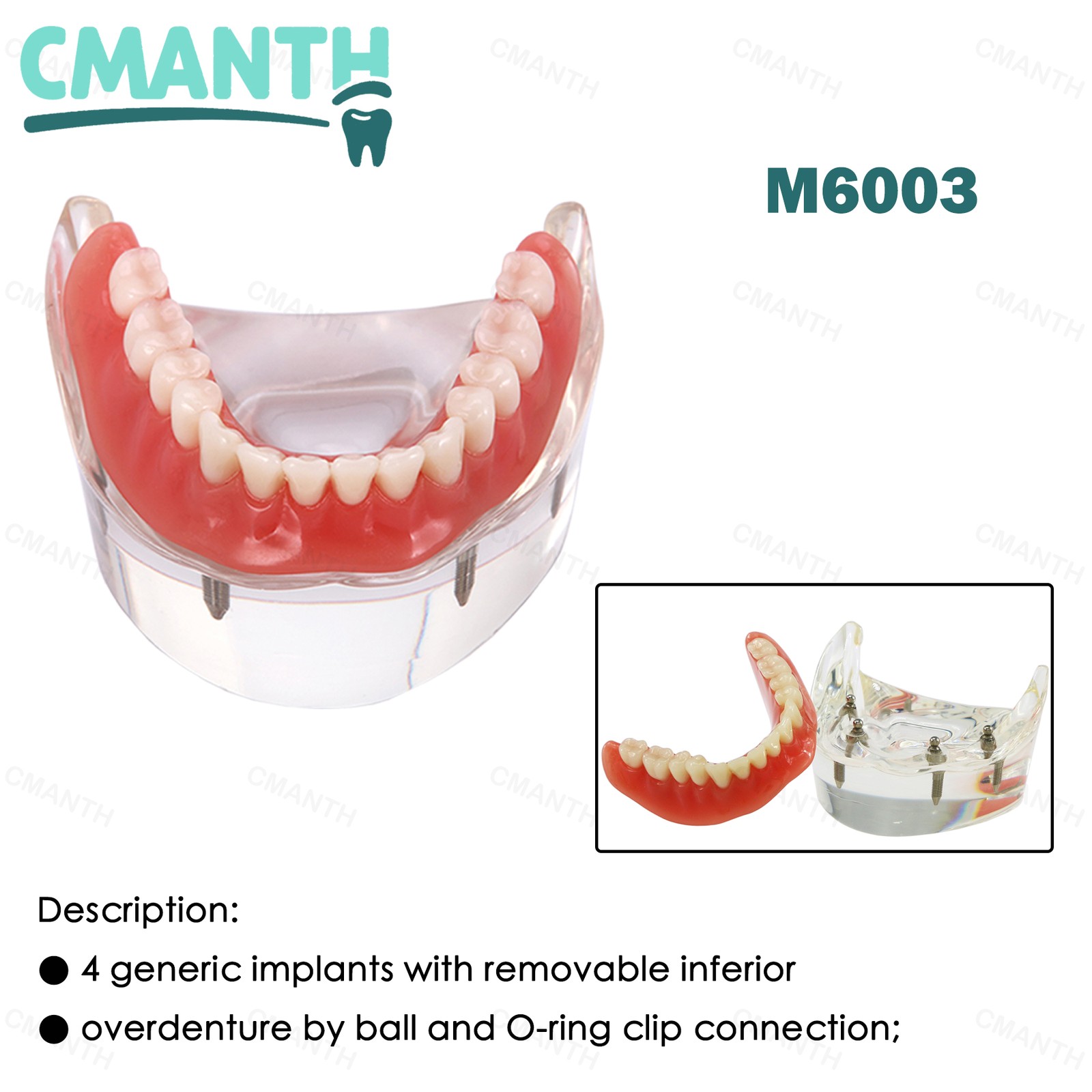 US Dental Removable Overdenture Teeth Model 4 lmplants Restoration Demo Clear