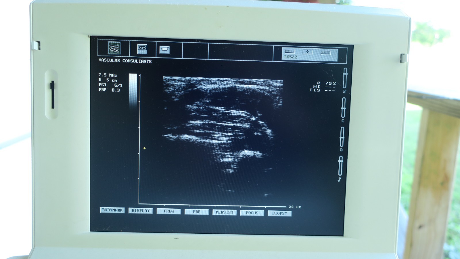 Biosound Esaote Caris Plus Ultrasound CARDIO & CFM Color Doppler – LA522E & ECG