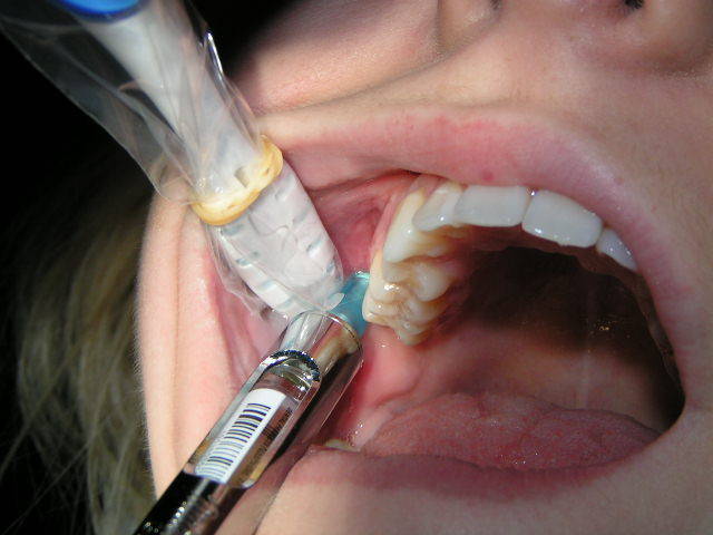 Vibrasthetic-Painless Injection Aide-Vibrates For Dental And Dermal Injections