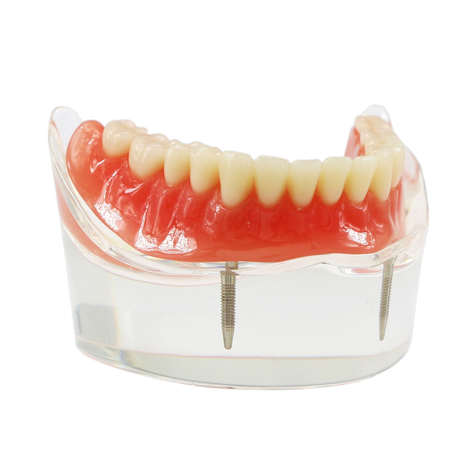 Dental Teeth Model 2 4 Implant Overdenture Typodont Restoration Demo Upper Lower