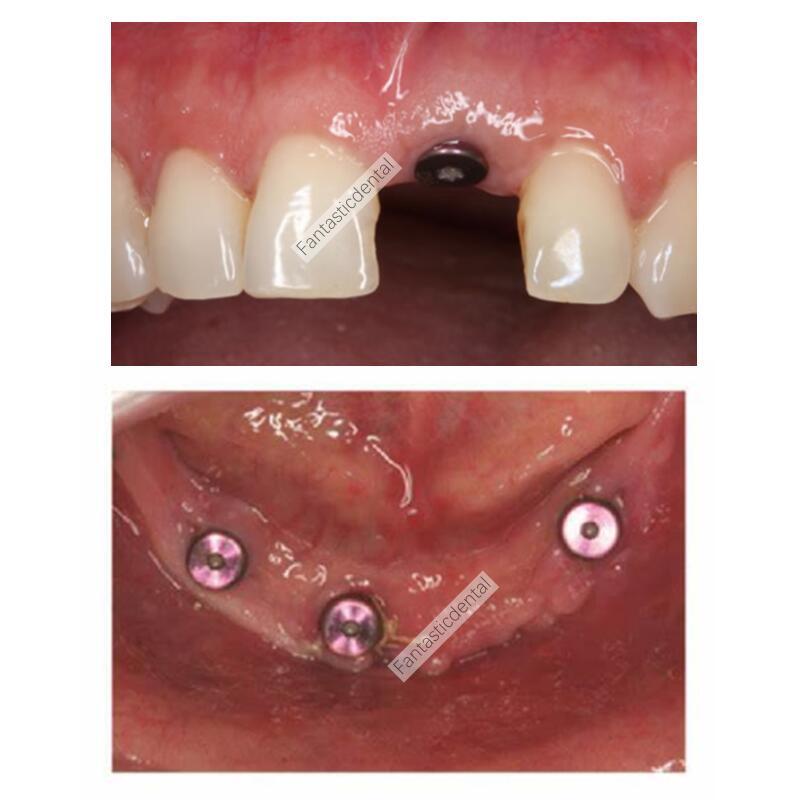RC Dental Healing Abutment Healing Closure Regular Fit Straumann ITI Bone Level