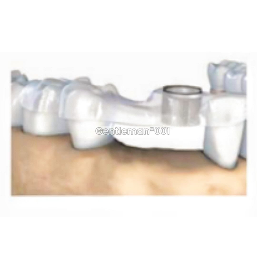 10Pcs Dental Digital Guided Sleeves Implant Template Fixed Universal ITI DIO DEN