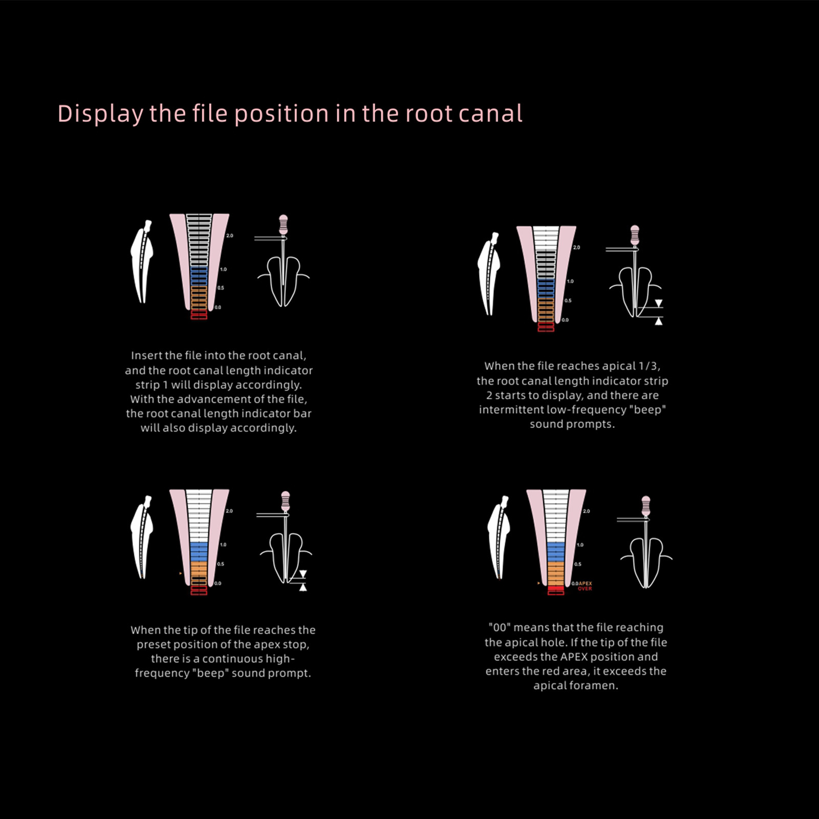 Woodpecker Dental Woodpex V 4.5’’ LCD Apex Locator Endodontic Root Canal Finder