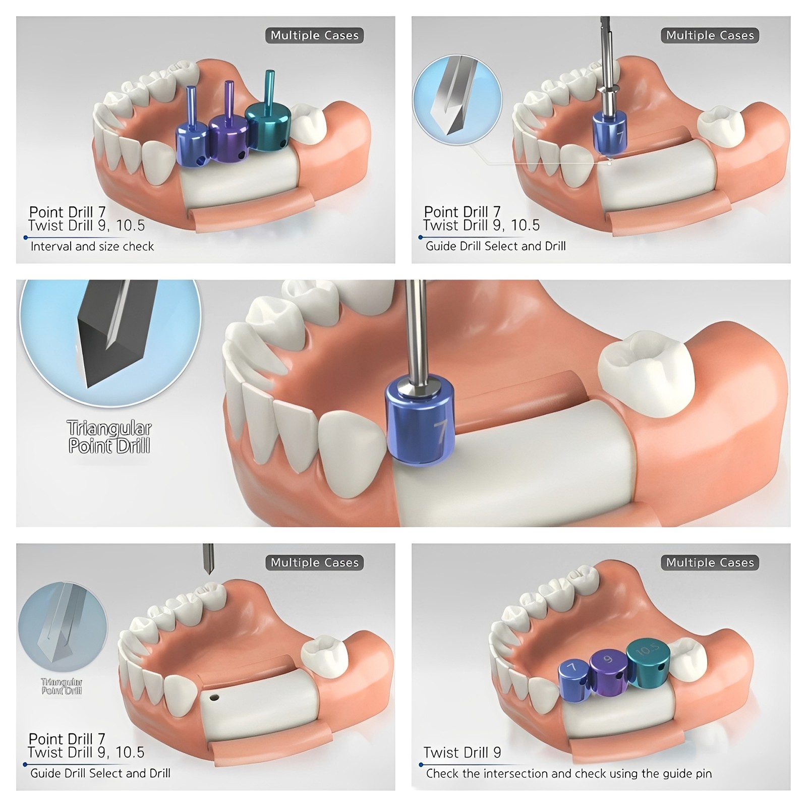 Dental Implant Drill Guide Positioning Space Drill Pilot Pins Spacing An Implant