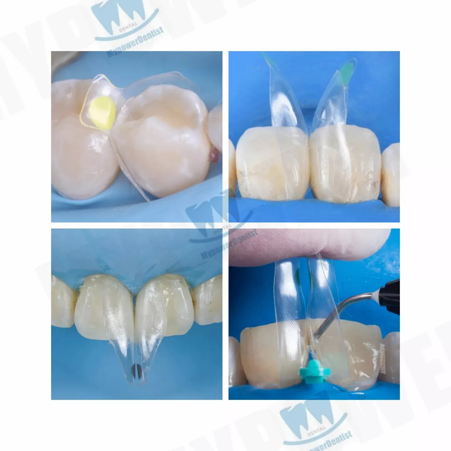 Clear Matrix Dental Diastema Matrices Wedge Similar with Bio Clear Matrice TORVM