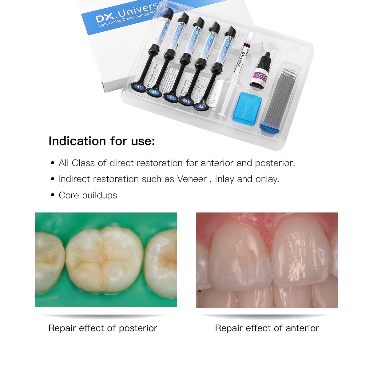 Dental Light Cure Composite Resin Etching Gel Donding A1 A2 A3 A3.5 B1 Kit