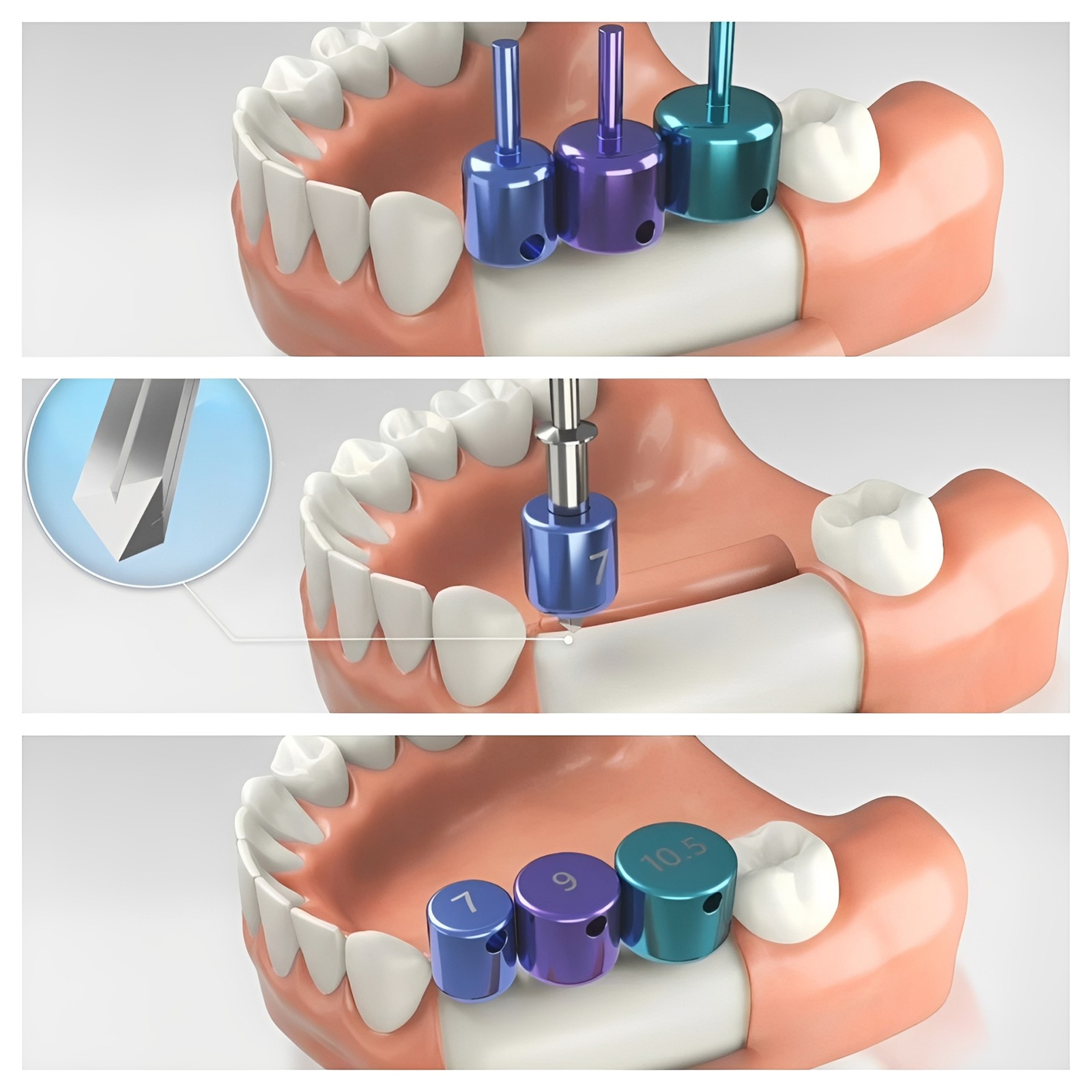 Dental Implant Drill Guide Positioning Space Drill Pilot Pins Spacing An Implant