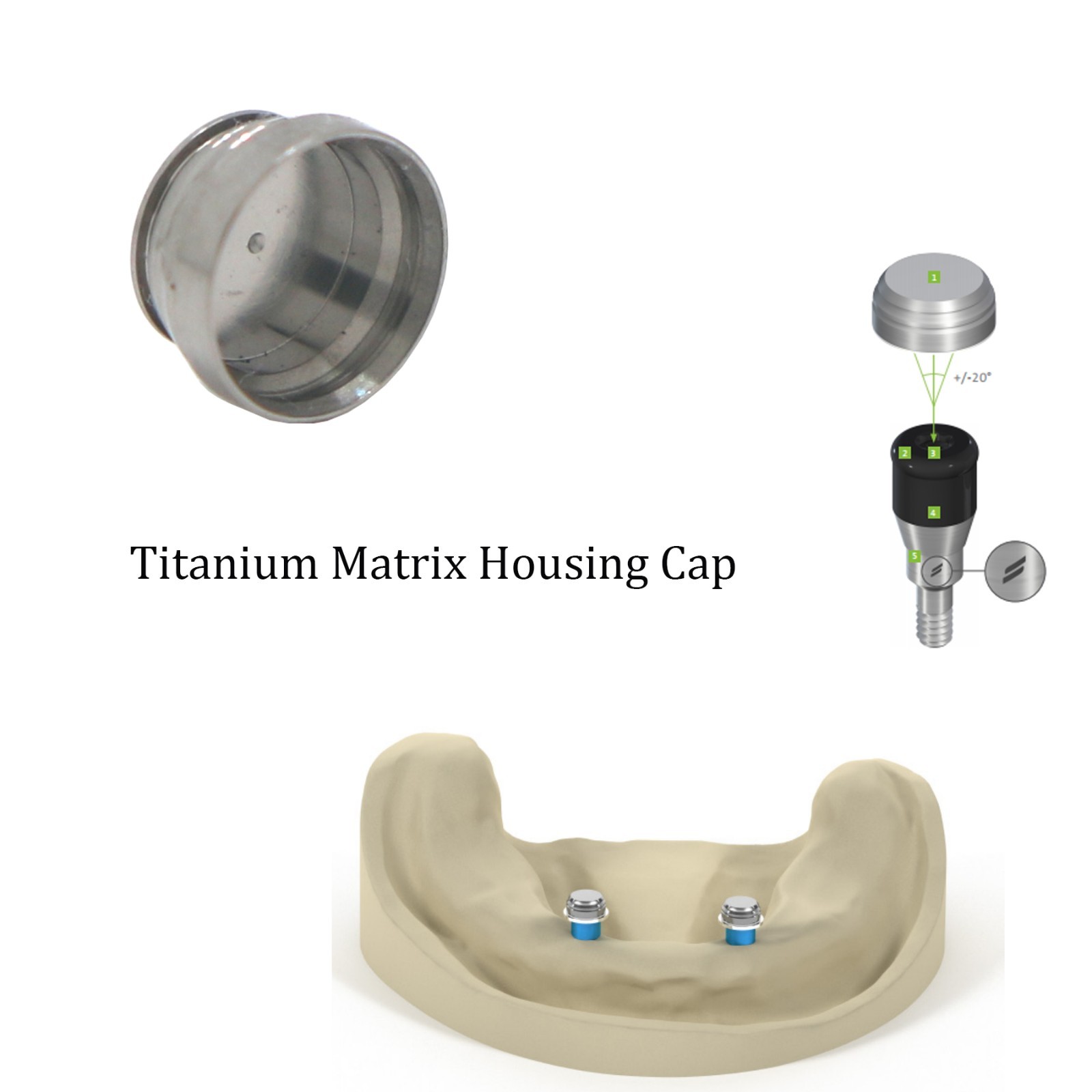 US Dental Retention Insert Cap Set For Navoloc Male Caps Insert Kit Locator Zest