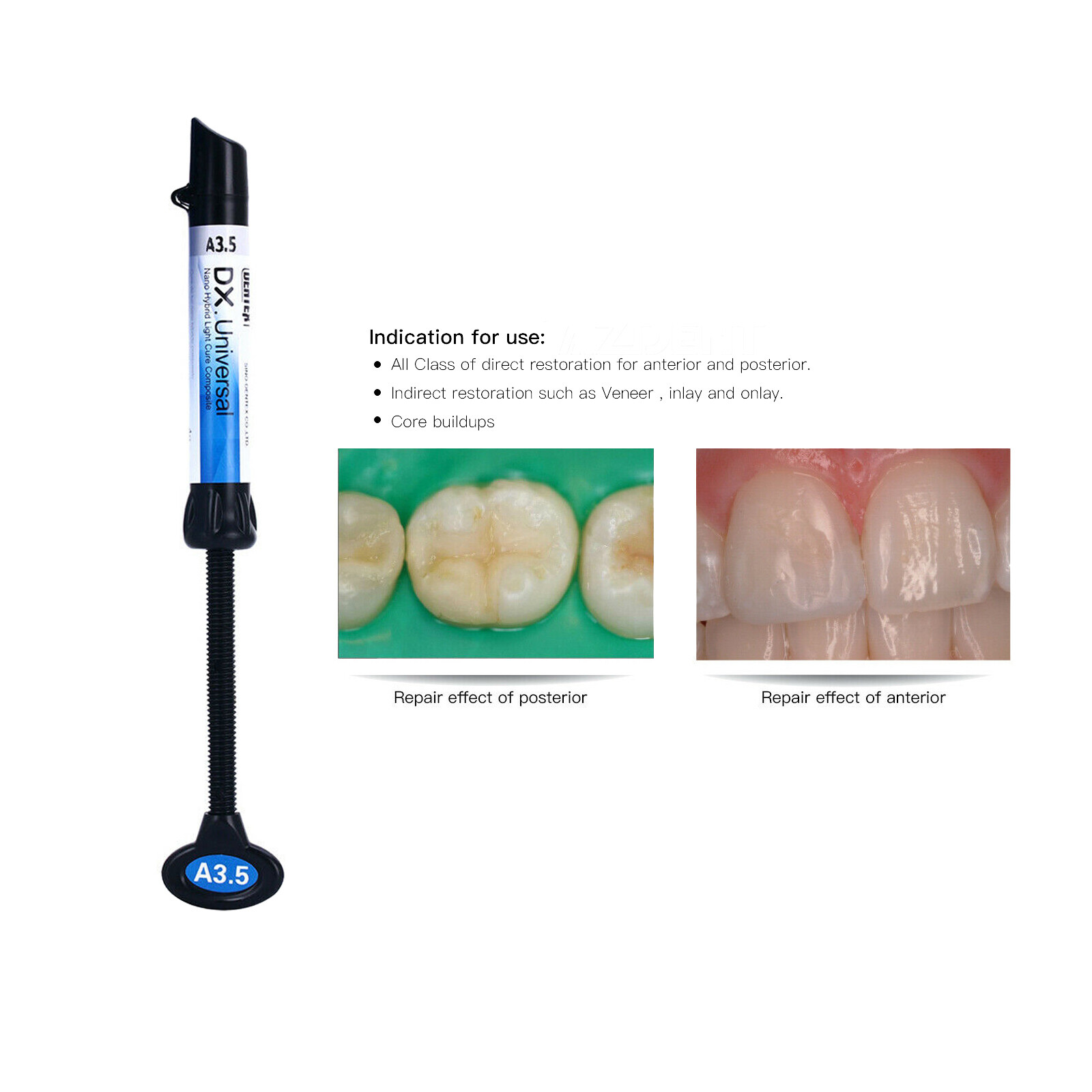 Dentex Dental DX Universal Light Cure Composite Resin Teeth Filling Material