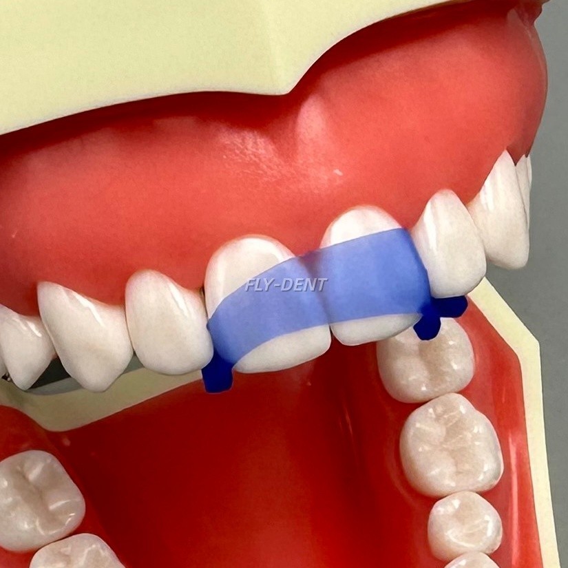 Dental Contoured Anterior Elastic Wedges For Front Anterior Teeth Strip Whiting