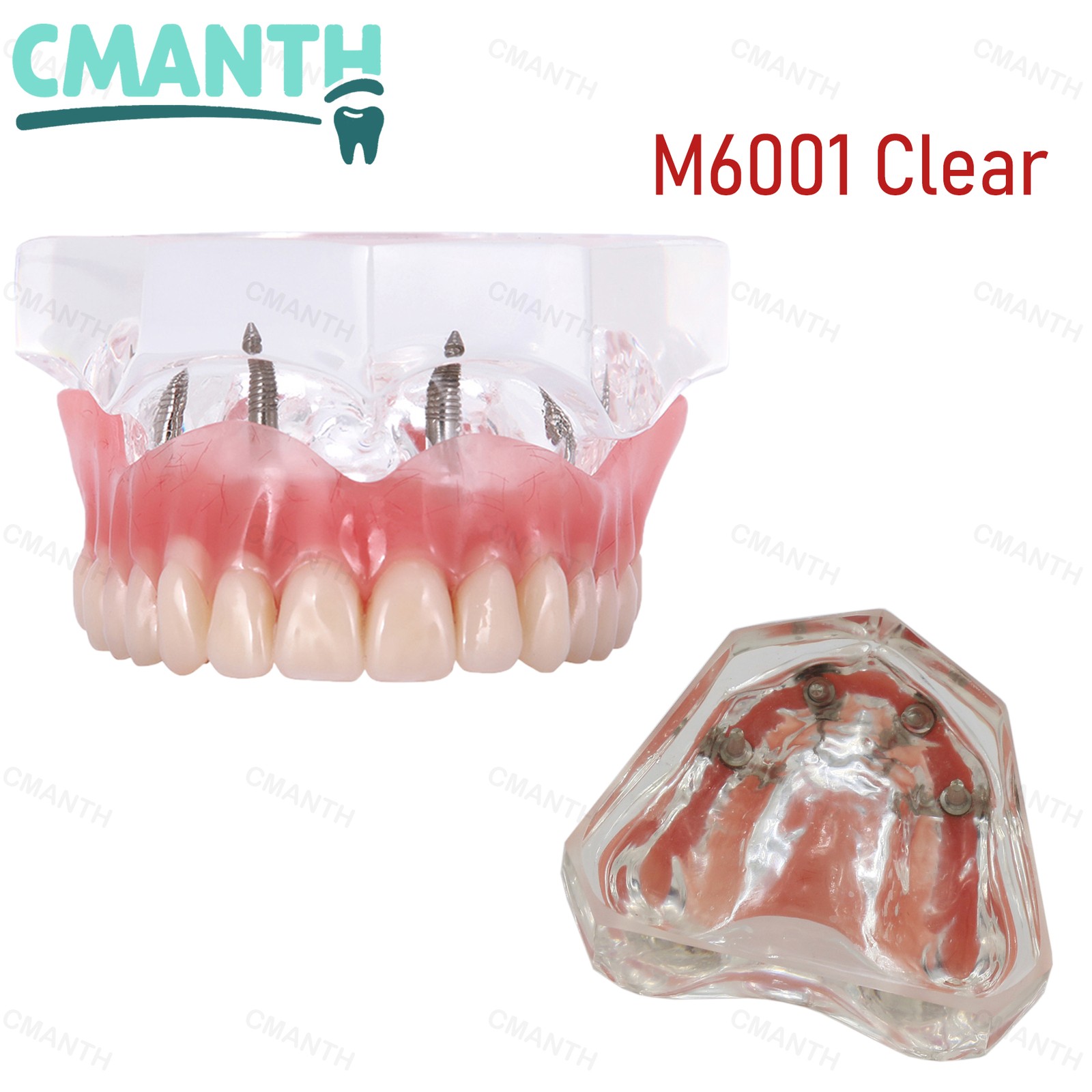 US Dental Model Clear Upper Lower 4 Implants Overdenture Restoration Removable