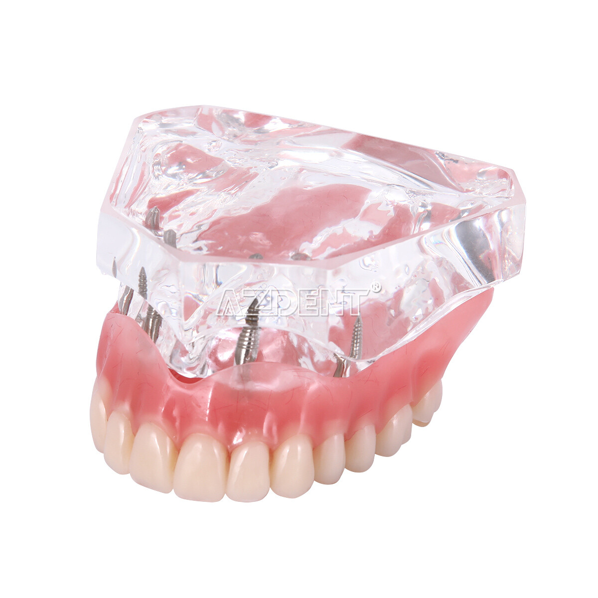 Dental Implant Teeth Model Demo Overdenture Restoration with 2/4 Implants U/L