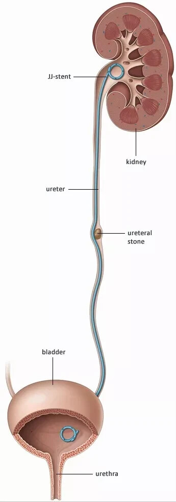Double J stent with pusher urology 5Fr 26cm 50 pieces DJ Stent FREE SHIPPING