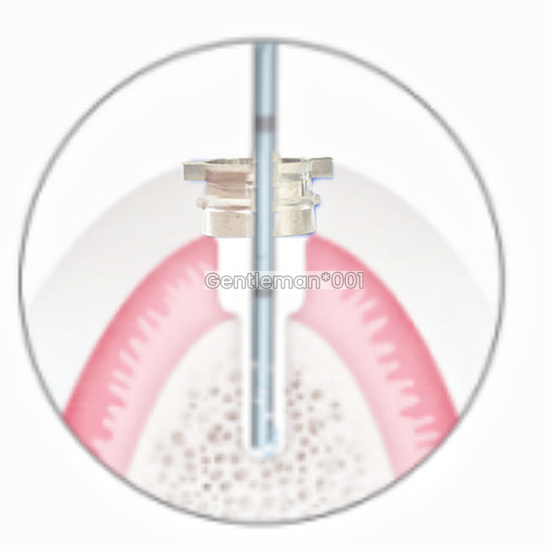 10Pcs Dental Digital Guided Sleeves Implant Template Fixed Universal ITI DIO DEN