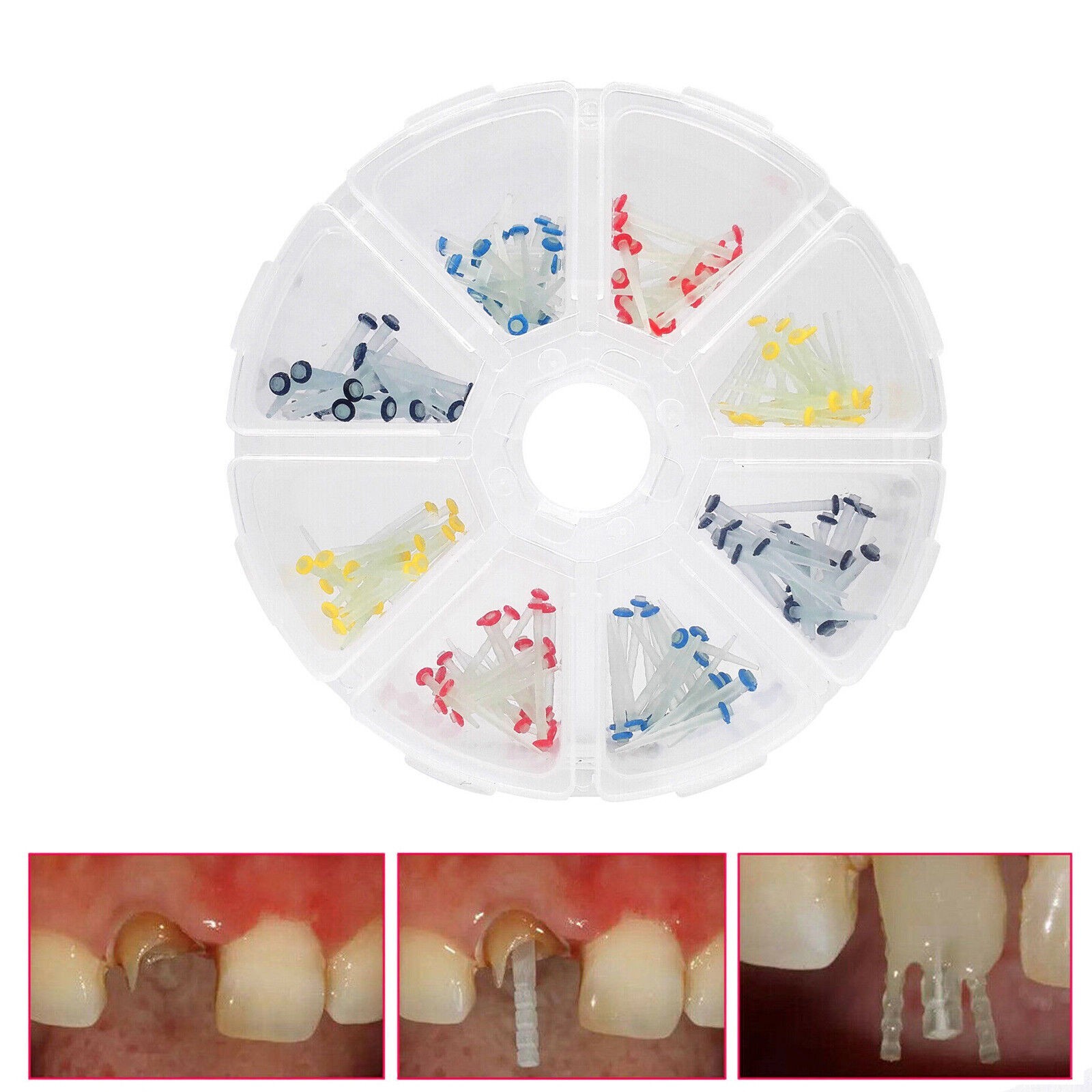 200Pcs Dental Fiber Post Glass Quartz Teeth Restorative 1.0 1.2 1.4 1.6 1.8mm