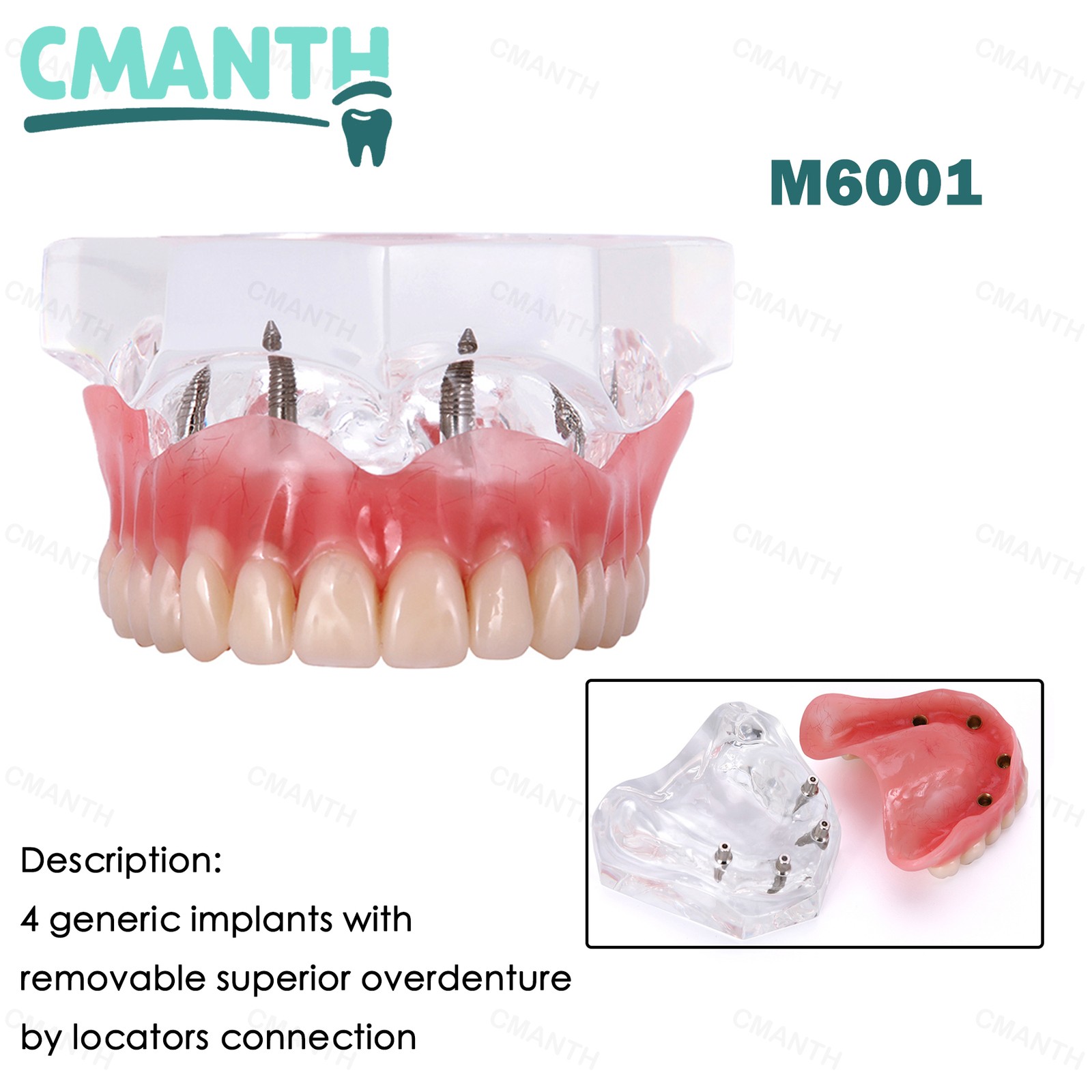 US Dental Removable Overdenture Teeth Model 4 lmplants Restoration Demo Clear