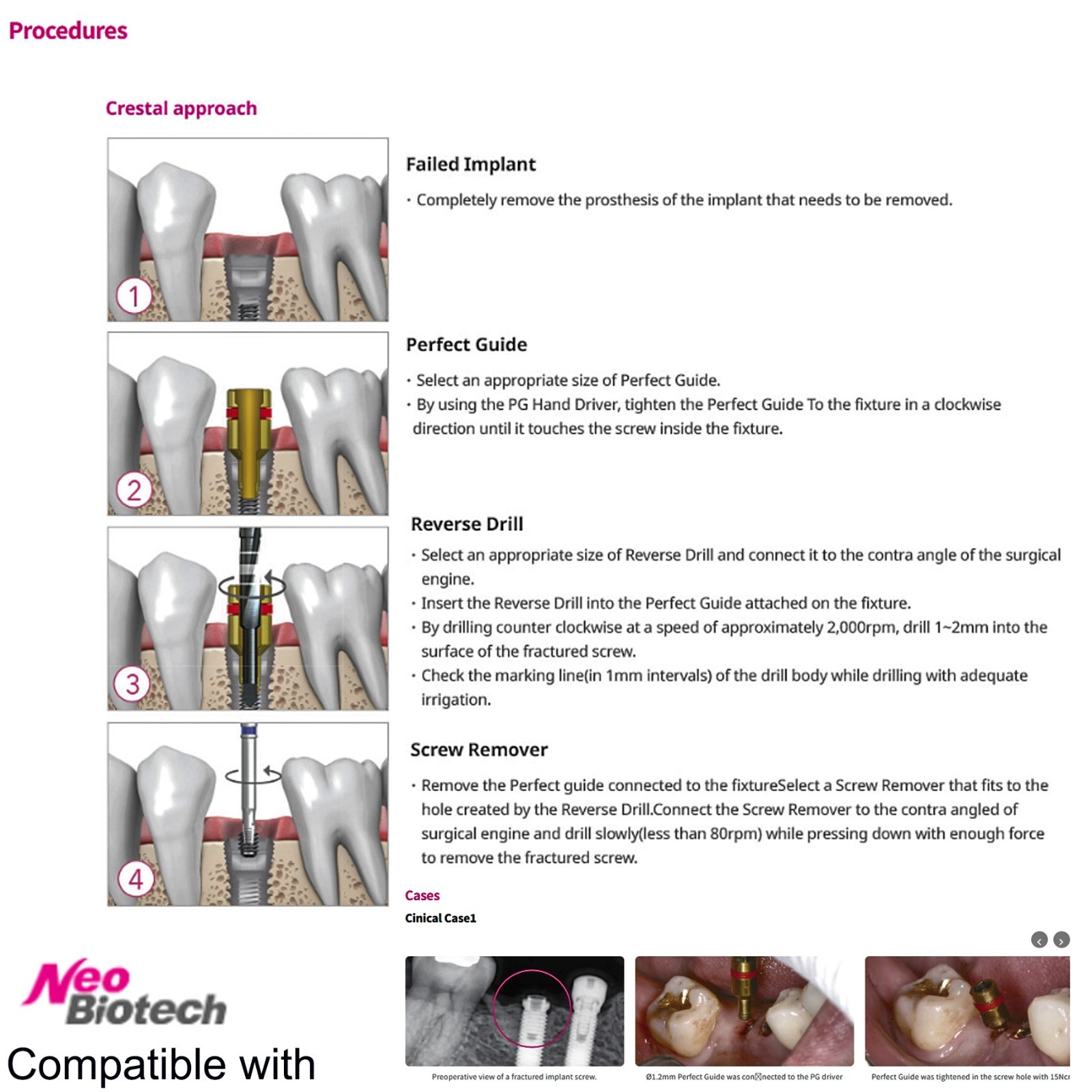 US Implant Fixture & Fractured Screw Removal Kit MCT FSRK-02 NeoBiotech SR