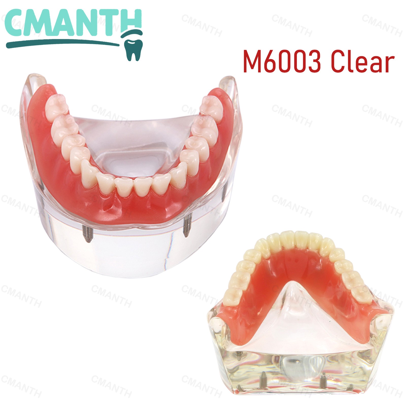 US Dental Removable Overdenture Teeth Model 4 lmplants Restoration Demo Clear