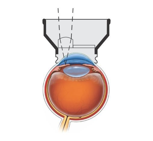 ND YAG Iridectomy Laser Lens For Vision Correction