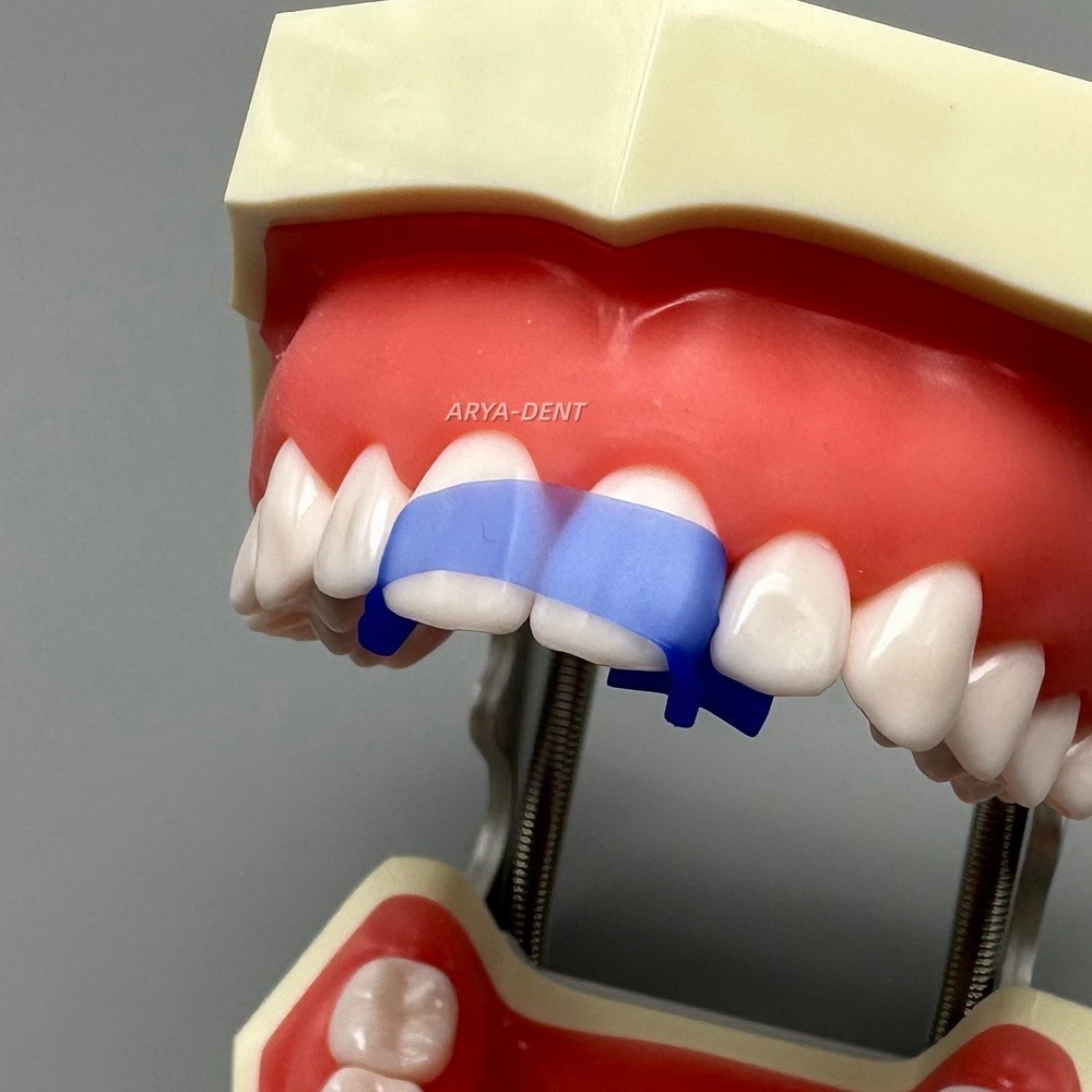 Dental Anterior Elastic Wedges Front Anterior Teeth Matrices Wedge Autoclavable