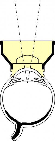 Ocular Abraham Capsulotomy OAYA
