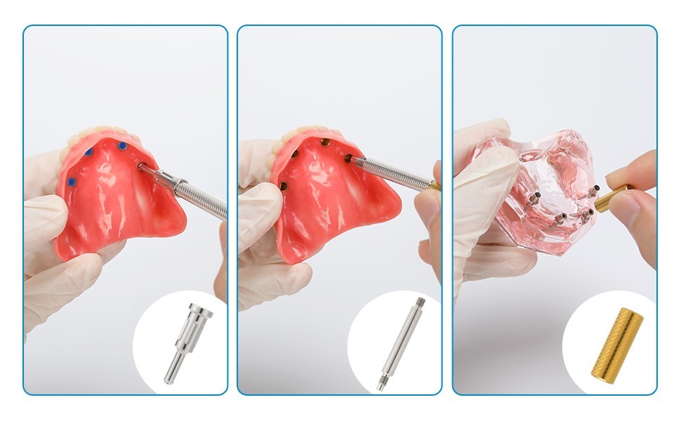 US Universal Overdenture Retention Caps Insertion Extraction Locator Core Tool