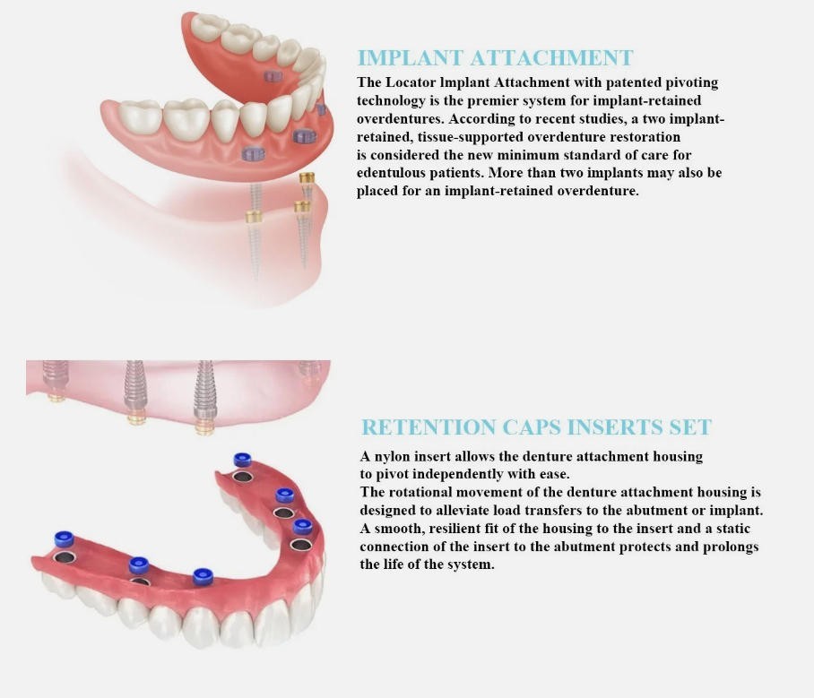 Dental Zest Locator Overdenture Attachment System Compatible Multiple Implant