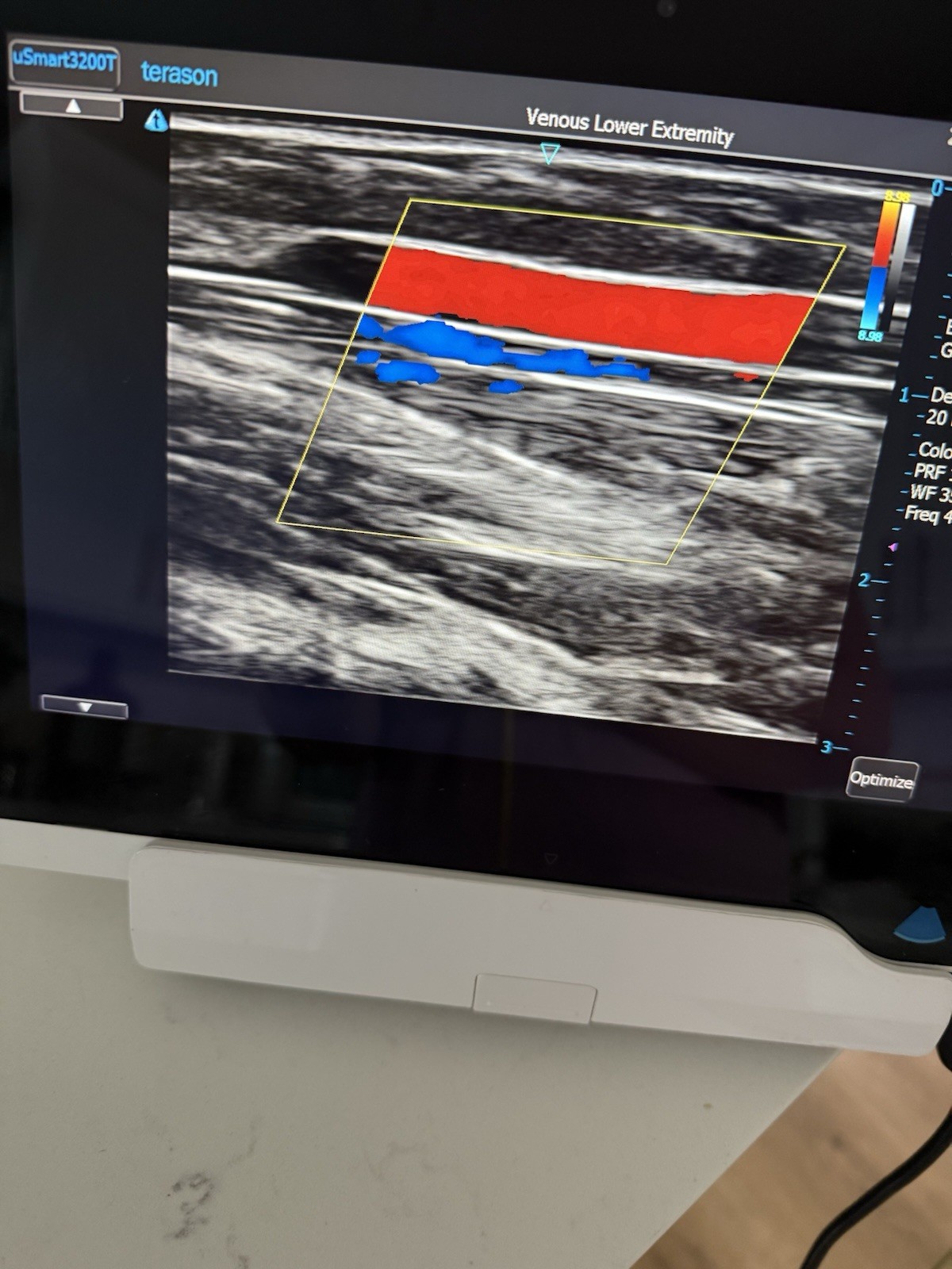 Terason uSmart3200T Laptop Portable Ultrasound Machine Color Doppler 2D Vascular