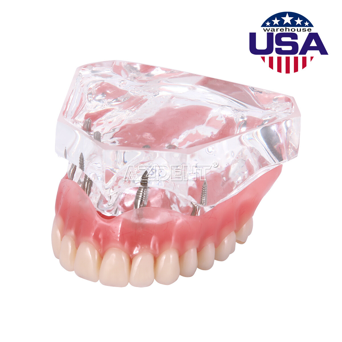 Dental Implant Teeth Model U/ L Demo Overdenture Restoration w/ 2 4 Implants