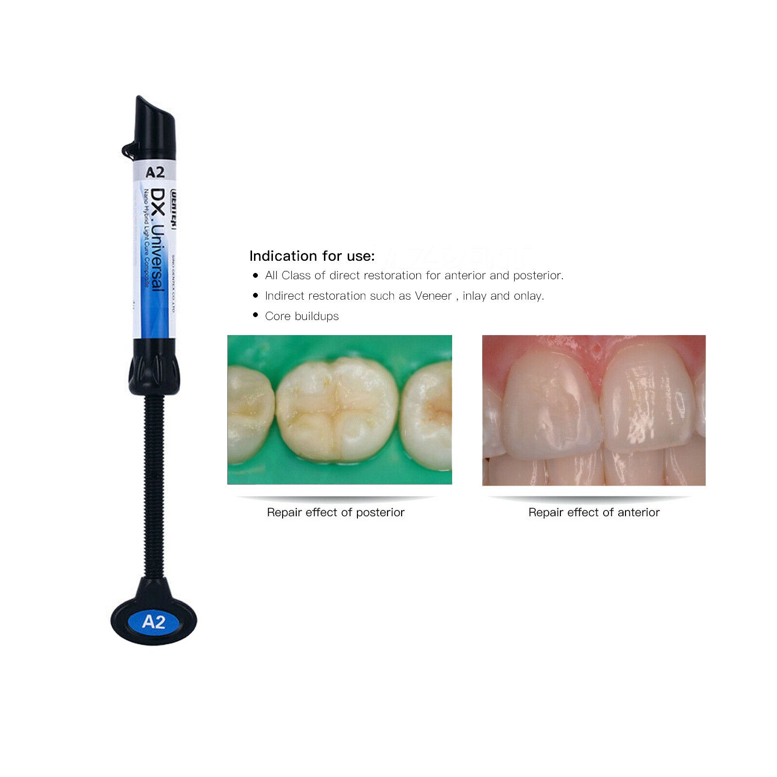 Dentex Dental DX Universal Light Cure Composite Resin Teeth Filling Material