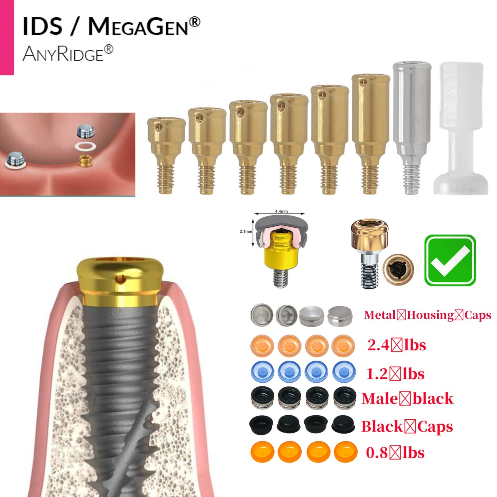 Dental Zest Locator Overdenture Attachment System Compatible Multiple Implant