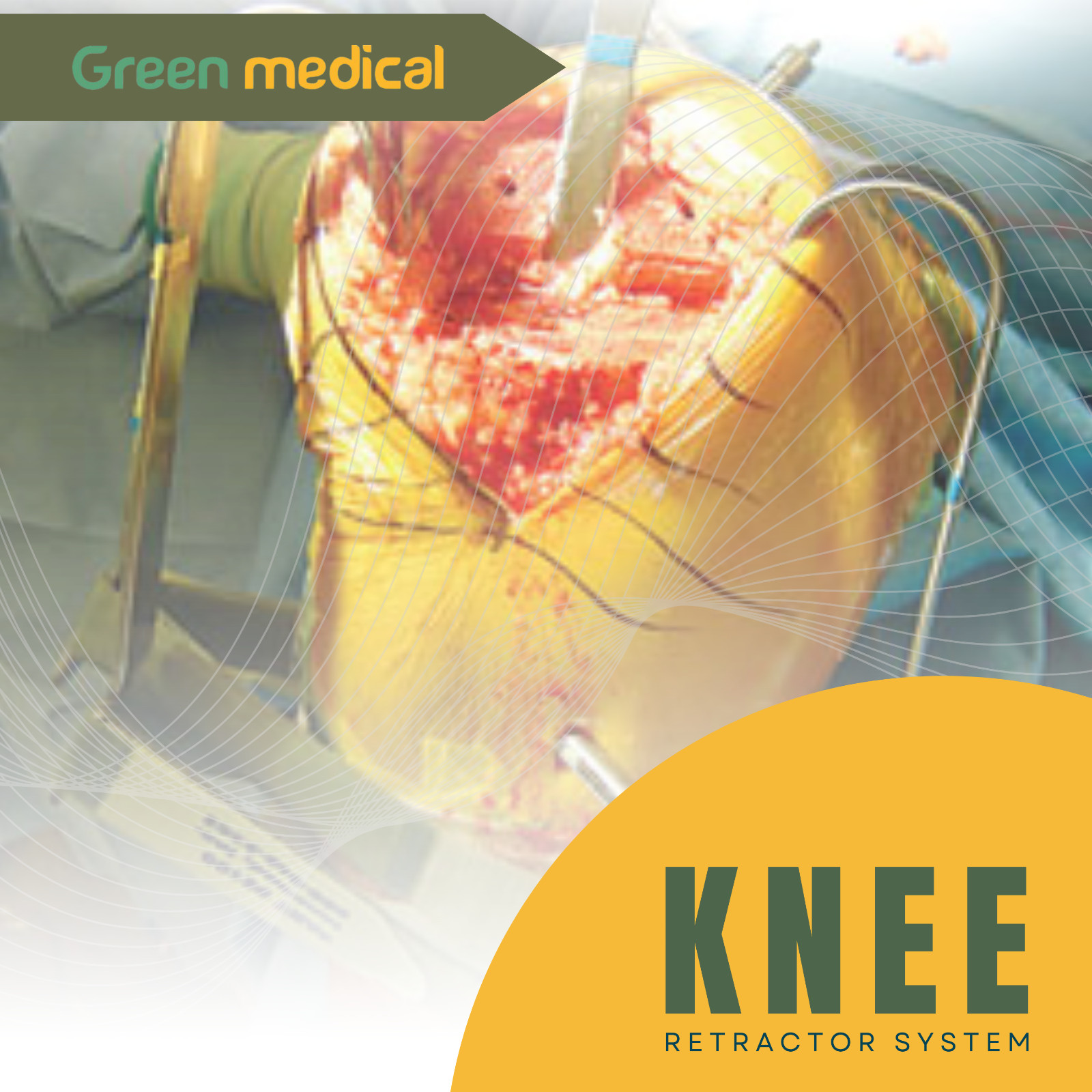 Collateral Ligament Retractor – Long Prong Orthopedic Surgical Instrument