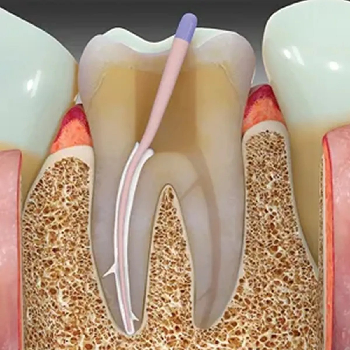 DentsMind DM ROOT High Flowability Bioceramic Sealer 2gm for RCT Treatments