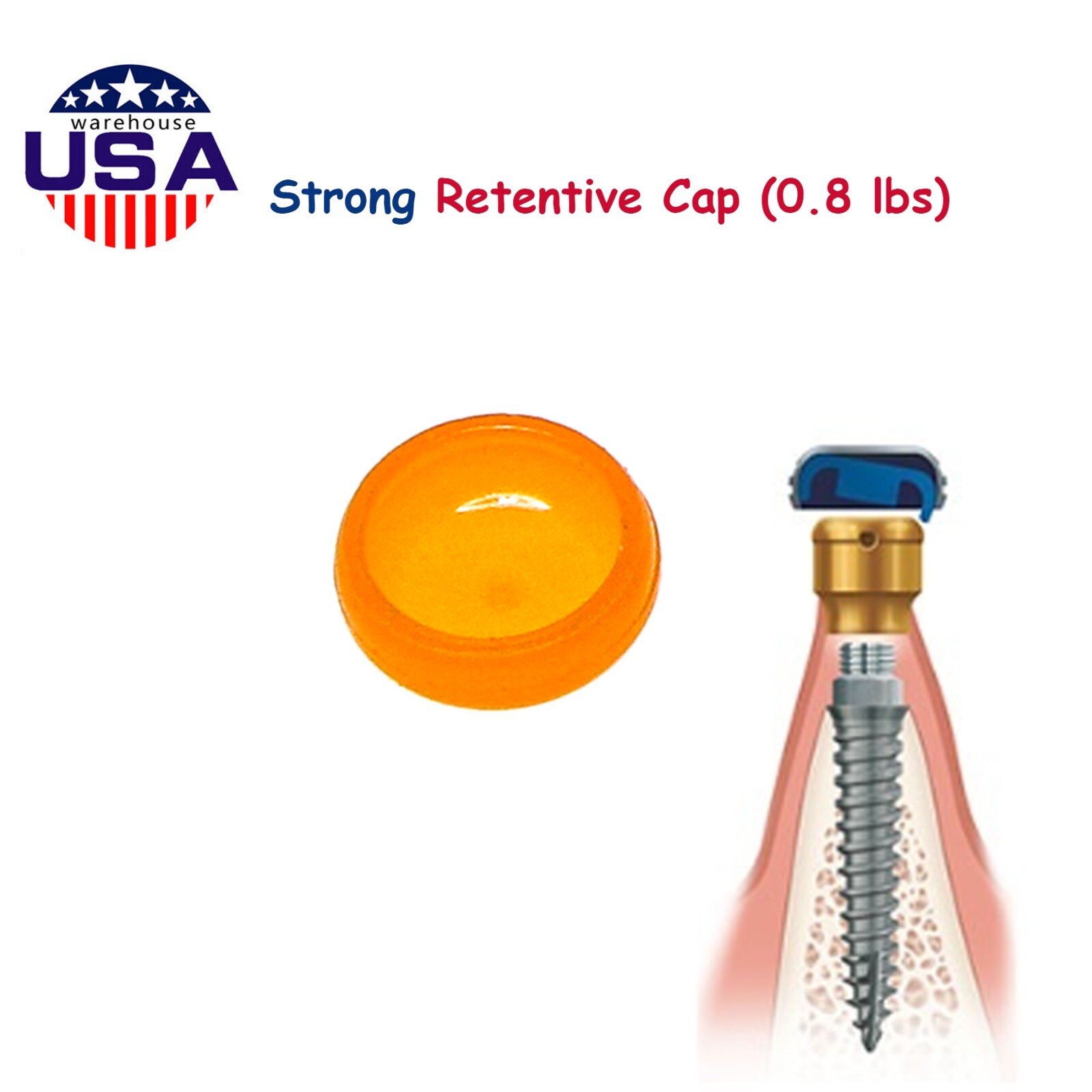 Locator Caps w/ PEEK Inserts 0.8-2.4lb Metal Housing & Spacers for Overdentures
